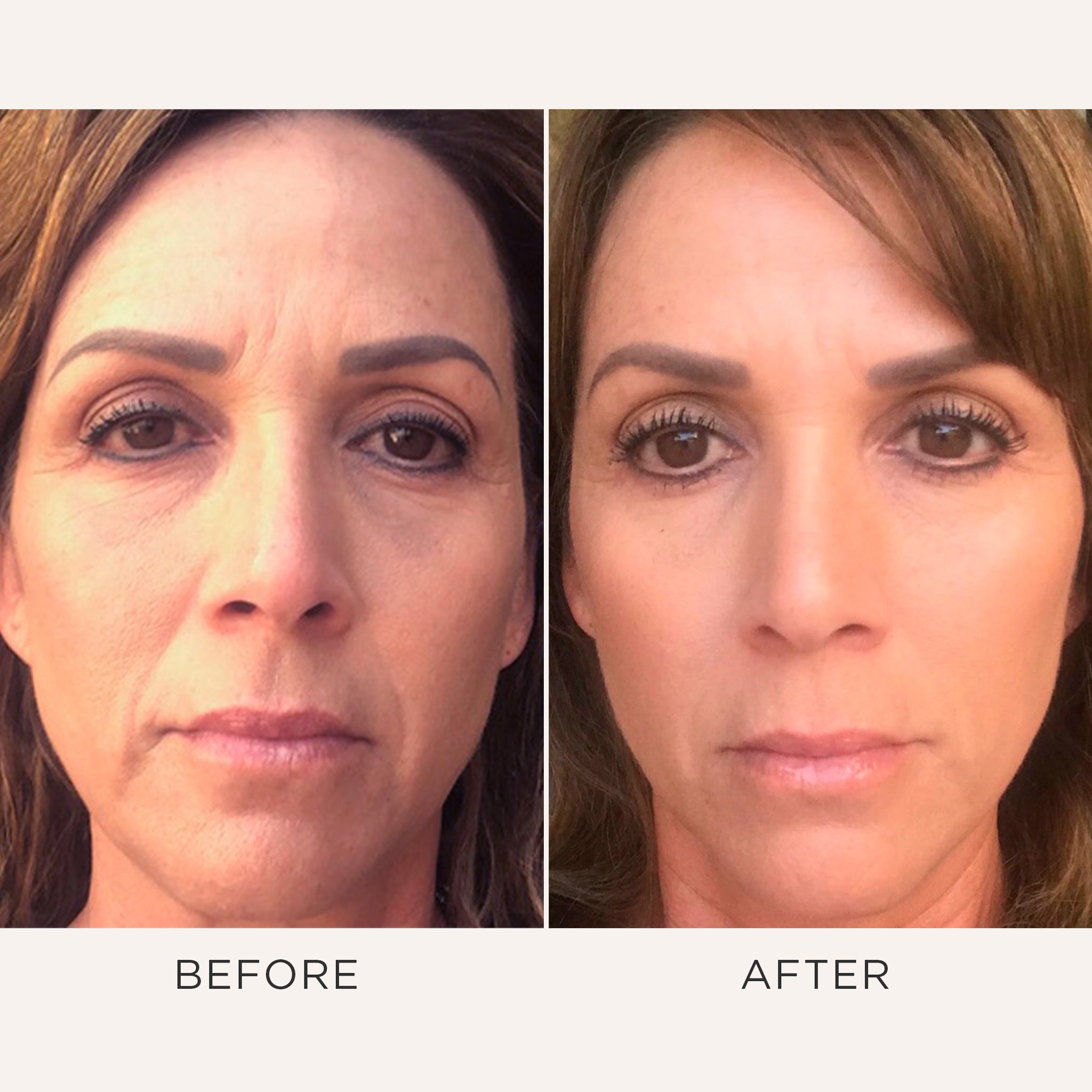 Recovery Before and After Results