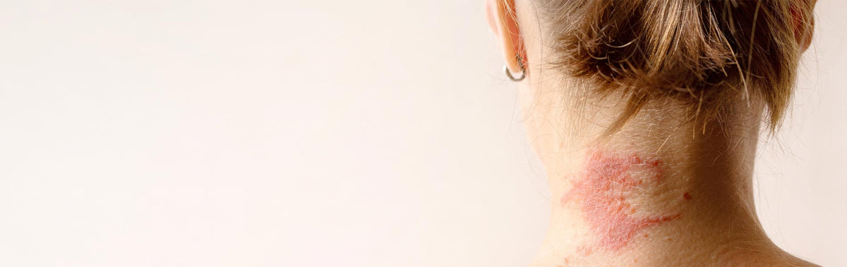 Eczema Awareness Month: A Gentle Routine for Dry, Sensitive Skin