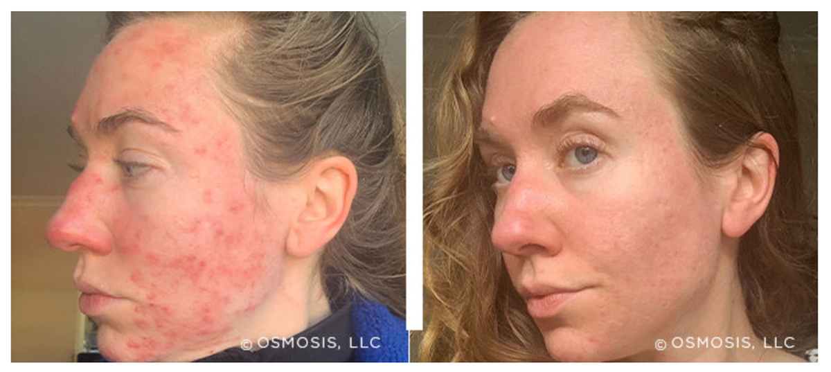 Before and after image of a woman showing improvement in acne