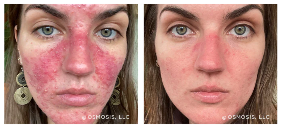 Before and after image of a woman showing improvement in acne