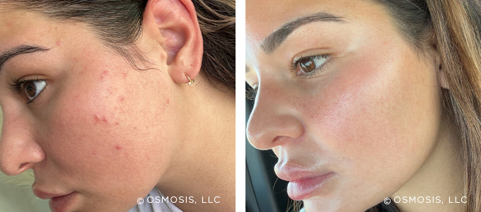 Osmosis Blemish Before & After Side Face
