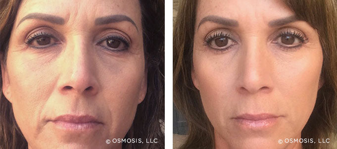 Osmosis Recovery Before & After Full Face