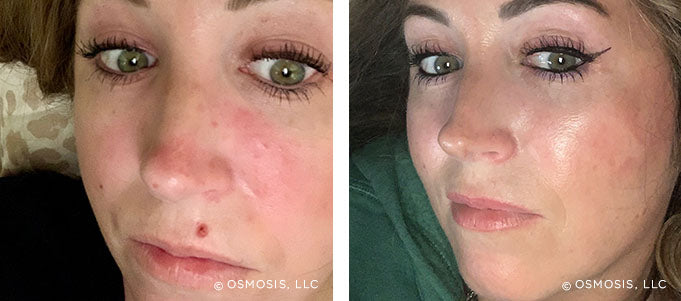 Before and after comparison of a woman's face with visible skin condition on the left and clear skin on the right.